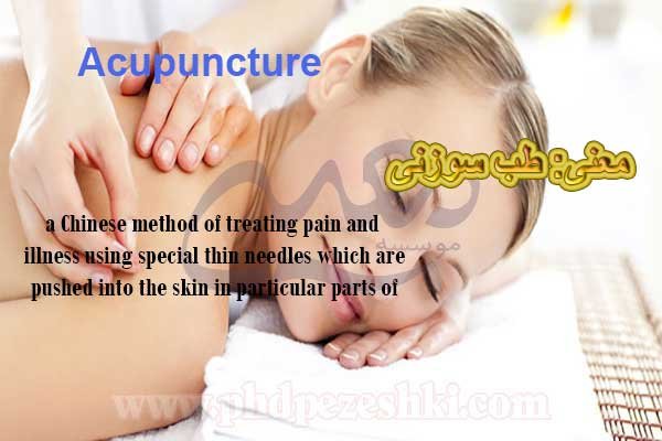 Acupuncture